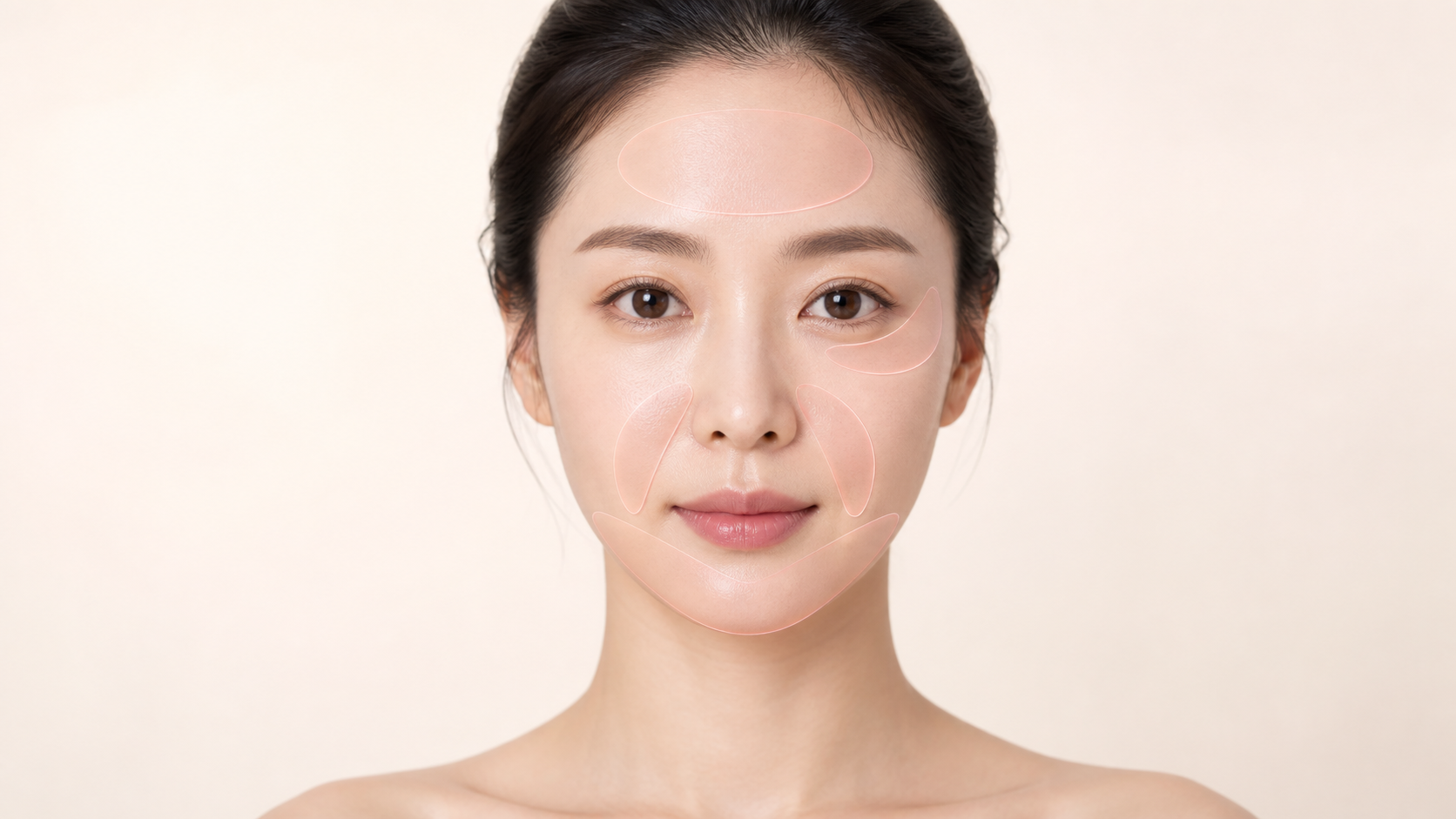 매선실 적용 부위